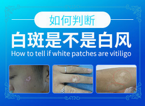 神经节段型白颠为什么难治