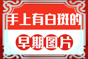 婴儿腿上有白斑是怎么回事