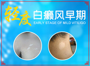 兰州城关区治疗白癜风较好的医院有几家