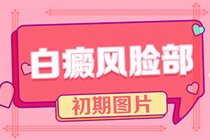治疗白斑的方法[近期公开]眼部白癜风怎么办