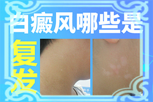哪种白颠清药效治白颠效果好