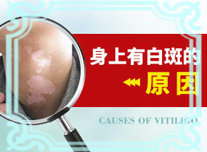 小孩脸上一块白一块白是什么原因看什么科