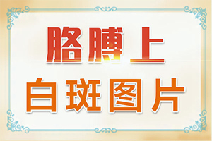 兰州安宁区白癜风治的非常好的医院在哪