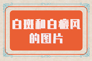 白点癫风会一直遗传下去吗图片