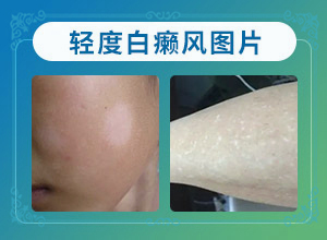 脸上白了一小块是什么原因有没有传染