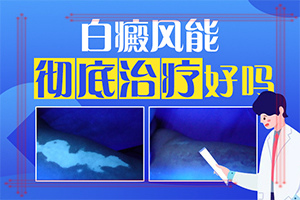 怎么分辨是不是白斑[患者力荐]白巅峰前期症状结巴吗
