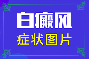 青海海东那家医院有308准分子激光白癜风