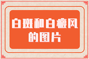 兰州皋兰县去哪家治疗白癜风医院好