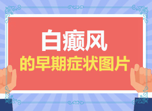 帮我搜一下白颠怎样治疗
