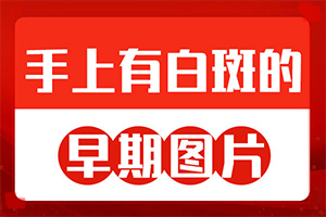 兰州安宁区哪家医院治疗白癜风较好