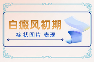 小孩子白点癫风多久可以治好啊
