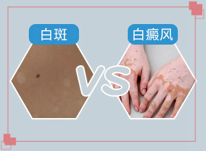 想看白癜风去兰州中研好不好