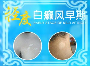 二岁小孩脸上有白块是什么原因造成的