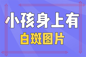 白巅峰的症状及预防[2022公开]白点癫风背部初期症状
