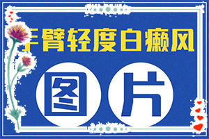 得了白颠疯病兰州中研怎么治好的快