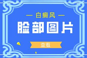 兰州安宁区白癜风治疗专业的医院是哪家