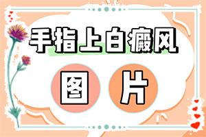 兰州安宁区白癜风治疗专业的医院是哪个
