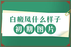 兰州安宁区哪个白癜风医院比较好的治疗