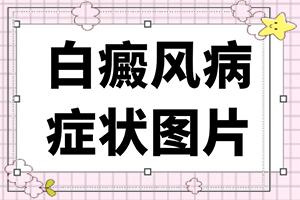 东莞哪间医院医白癜风比较好