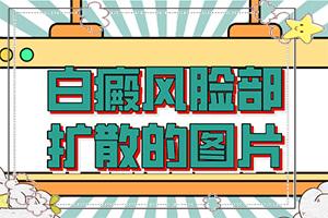 东莞医院哪家看白癜风较好