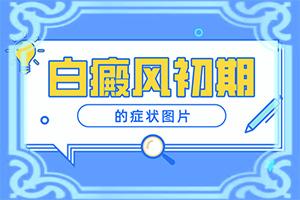 兰州皋兰县到哪家医院治疗白癜风较专业