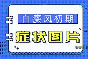 东莞哪个医院治疗白癜风治疗的较好