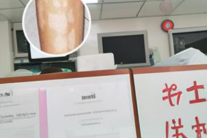 为何得白颠疯