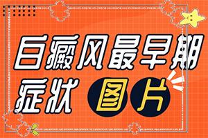 东莞专科白癜风医院哪家较
