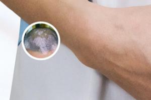 白癞风要吃什么药才能治疗