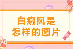 甘肃兰州哪家医院治疗白癜风比较好
