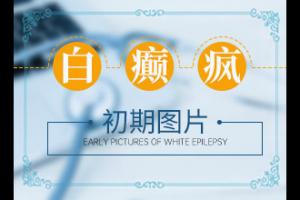 东莞白癜风能吗费用高不高