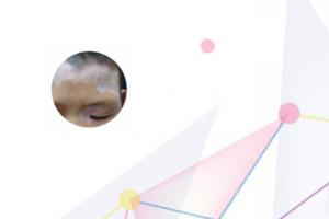 小儿白癫疯的治（小儿白颠疯严重吗）