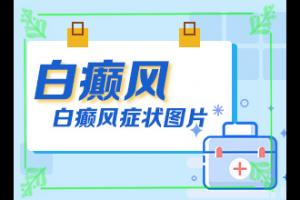 东莞长安治白癫风的医院哪家好