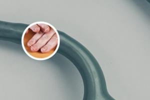 手上白点癫风能治好吗会传染吗怎么治疗