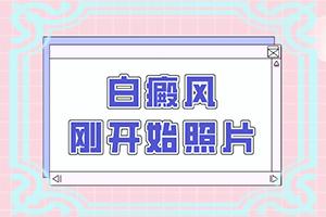 兰州高新区到哪家医院治疗白癜风较专业