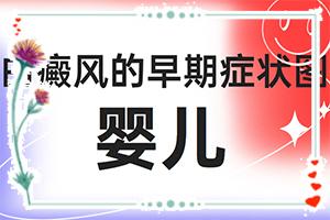 东莞白癜风治疗较好的专科医院