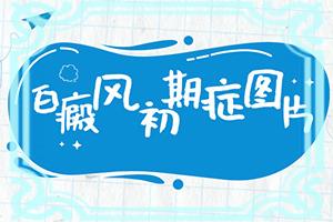 兰州七里河区哪家医院治疗白癜风较好