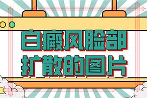 东莞治疗儿童白癜风什么医院安