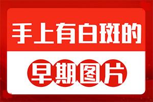 兰州安宁区哪家医院治疗白癜风较好