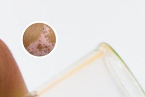 白癫风早期有什么症状