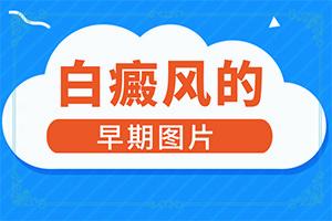 东莞有没有能看好白癜风的医院
