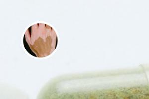 白癜风传染性（白巅风传吗）