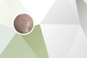 白点癫风用药后出现疙瘩怎么回事儿啊图片