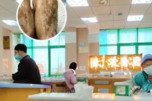 白癜风跟甲醛有关吗