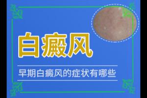 东莞哪家医院白癜风治疗的较好