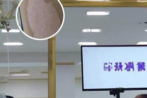白癜风光疗多久能治好