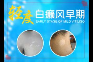 兰州安宁区有啥治疗白癫疯的专科医院吗