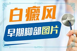 兰州皋兰县白癜风治疗到哪家医院非常好