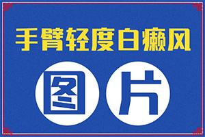 东莞看白癜风去哪家医院较好
