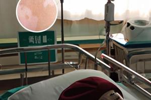 注射用甲泼尼龙琥珀酸钠效果